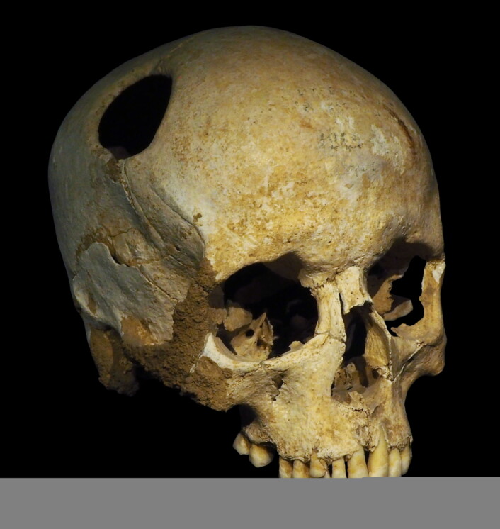 En trepanert hodeskalle fra steinalderen. (Bilde: Rama/CC BY-SA 3.0) En trepanert hodeskalle fra steinalderen. (Bilde: Rama/CC BY-SA 3.0)