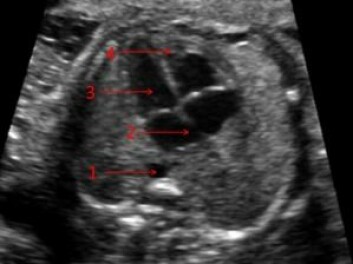 <em>Ultralydbilde av fosterhjerte. 1: Hovedpulsåre. 2: Åpningen mellom høyre og venstre forkammer kalt "foramen ovale". 3: Venstre forkammer. 4: Høyre hovedkammer. Foto: OUS.</em>