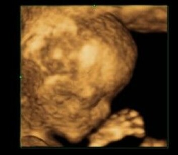 <em>3D-bilde av et foster i første trimester. Foto: OUS.</em>
