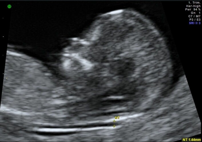 <em>Ansiktsprofil av foster i første trimester med fremvisning av nesebein og nakketranslusens. (Foto: OUS)</em>