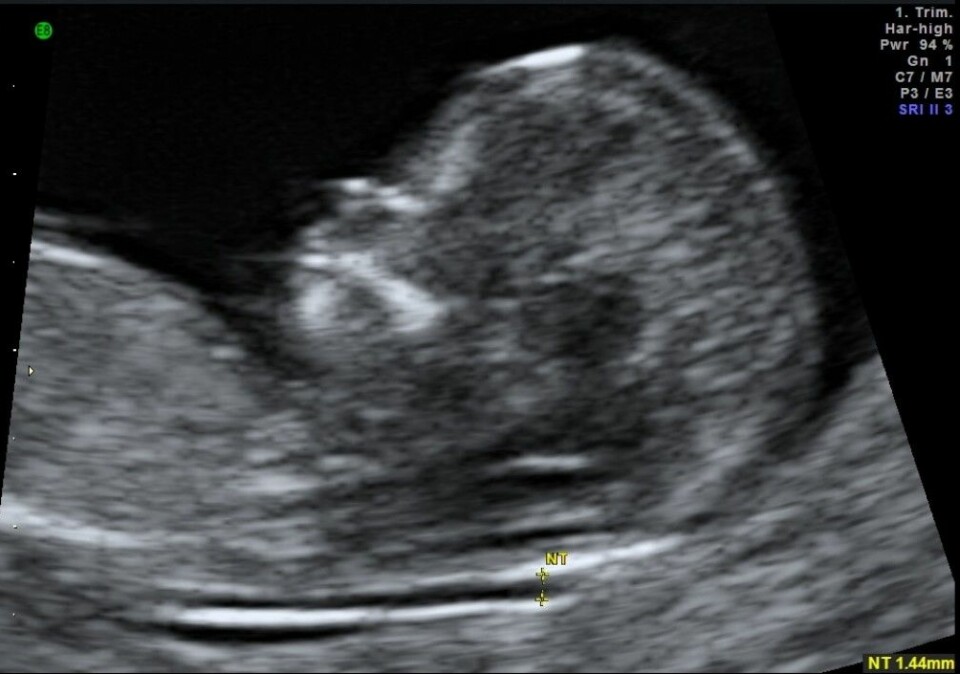 Ansiktsprofil av foster i første trimester med fremvisning av nesebein og nakketranslusens. (Foto: OUS)