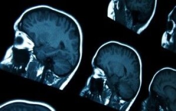 Sykdommer som Alzheimers synes på MRI-bilder av hjernen. (Foto: Colourbox) Sykdommer som Alzheimers synes på MRI-bilder av hjernen. (Foto: Colourbox)