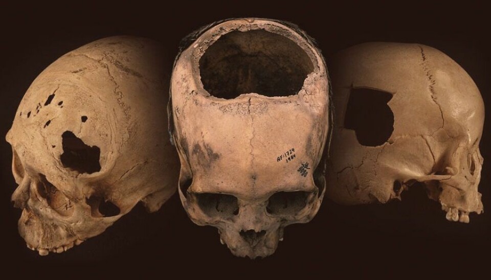 Eldgamle hodeskaller funnet i Peru har hull etter operasjoner. (Foto: University of Miami)