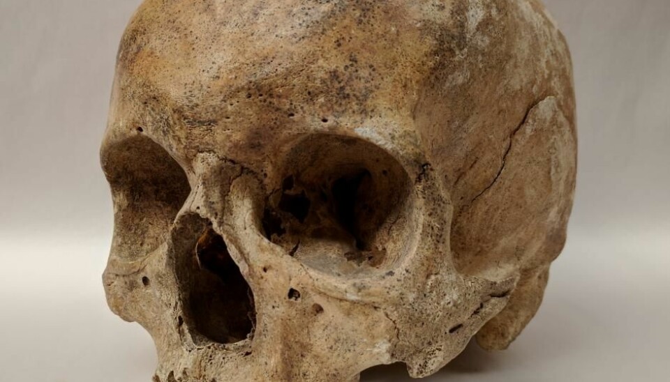 Skjelett fra et spedalskhetssykehus i Odense i Danmark har blitt undersøkt i en ny studie. Selv om de ble begravet for mer enn 700 år siden, kan forskerne fortsatt finne spor etter spedalskhetsbakterier på de gamle knoklene  (Foto: Dorthe Pedersen)