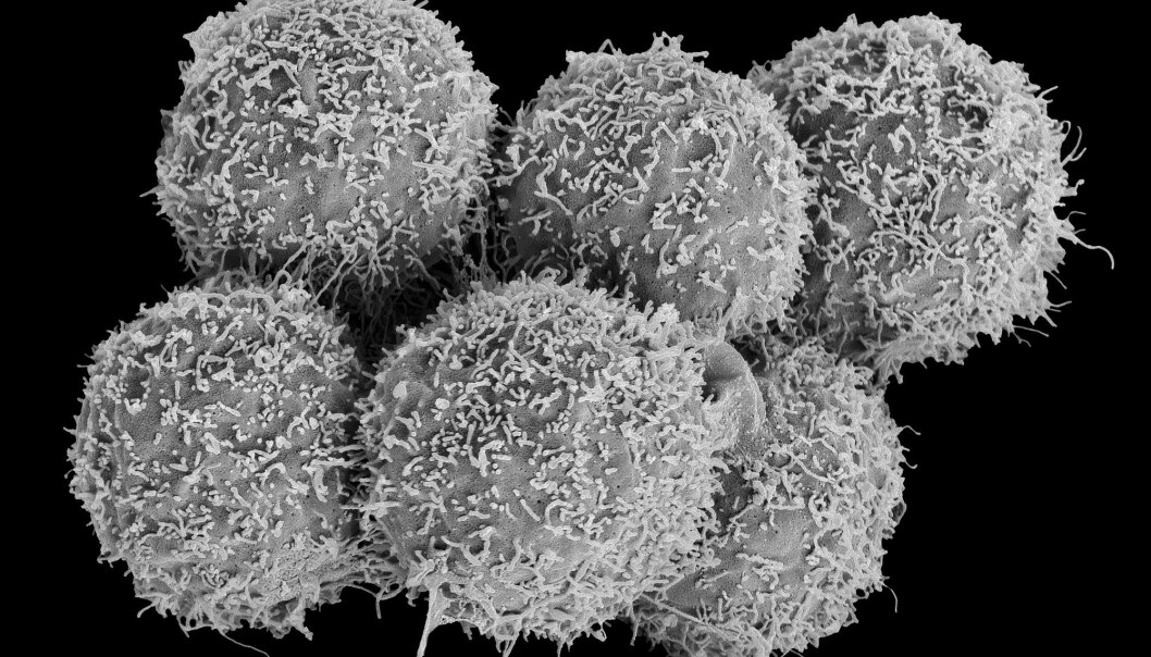 Kvinner går lenger med blærekreft før det oppdages. Det kan skyldes at legen regner med at smerter og blod i urinen skyldes blærekatarr. Her ser du blærekreftceller. (Foto: Science Photo Library, NTB scanpix) Kvinner går lenger med blærekreft før det oppdages. Det kan skyldes at legen regner med at smerter og blod i urinen skyldes blærekatarr. Her ser du blærekreftceller. (Foto: Science Photo Library, NTB scanpix)