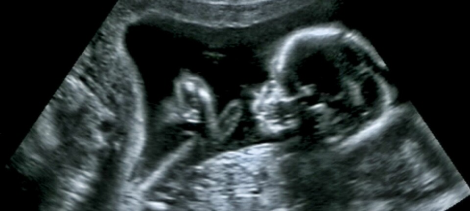 Når skal barnet fødes? De fleste graviditeter i Norge får en termindato basert på ultralyd. Men hvilke metoder fagfolkene bruker for å vurdere ultralydbildene på, er forskjellige.   (Foto: Shutterstock)