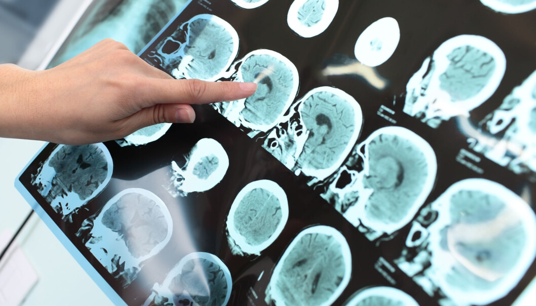 Effekten av Siponimod ser ut være liten. Men det er en tross alt en virkning, mot en variant av MS som hittil ikke har latt seg behandle. Illustrasjonsfoto: sfam_photo / Shutterstock / NTB scanpix) Effekten av Siponimod ser ut være liten. Men det er en tross alt en virkning, mot en variant av MS som hittil ikke har latt seg behandle. Illustrasjonsfoto: sfam_photo / Shutterstock / NTB scanpix)