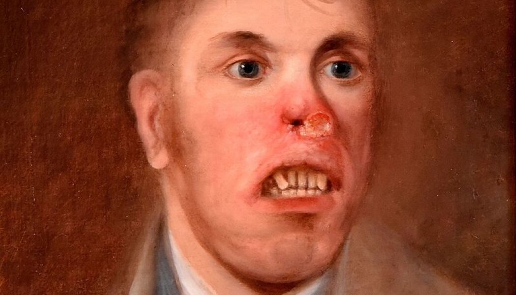 En portrett fra 1820 av en ung mann med syfilis, sannsynligvis medfødt, kalt Mr. Kay. Nesen er skadd av sykdommen. (Bilde: Ukjent, Wikimedia Commons) En portrett fra 1820 av en ung mann med syfilis, sannsynligvis medfødt, kalt Mr. Kay. Nesen er skadd av sykdommen. (Bilde: Ukjent, Wikimedia Commons)