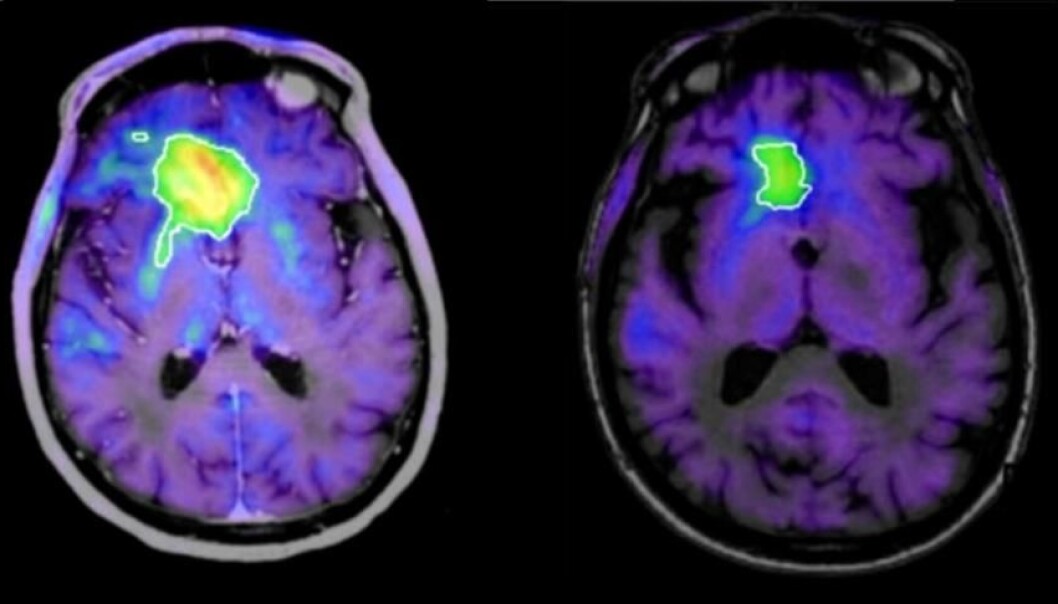 En eldre pasients hjernesvulst skrumpet etter at han hadde fått den nye formen for immunterapi, viser disse hjerneskanningene tatt henholdsvis 171 og 542 dager etter at behandlingen startet. (Foto: Kirkin et al., Nature Communications) En eldre pasients hjernesvulst skrumpet etter at han hadde fått den nye formen for immunterapi, viser disse hjerneskanningene tatt henholdsvis 171 og 542 dager etter at behandlingen startet. (Foto: Kirkin et al., Nature Communications)