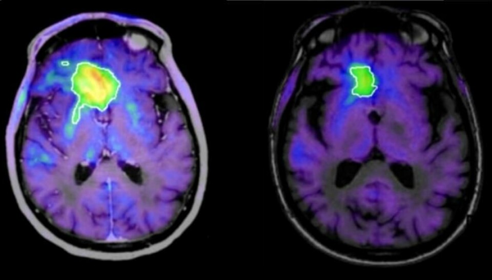 En eldre pasients hjernesvulst skrumpet etter at han hadde fått den nye formen for immunterapi, viser disse hjerneskanningene tatt henholdsvis 171 og 542 dager etter at behandlingen startet.  (Foto: Kirkin et al., Nature Communications)