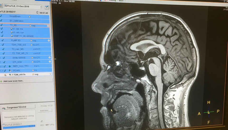 Beviset på at hodet er fullt av ... hjerne. (Foto: Eivind Torgersen)