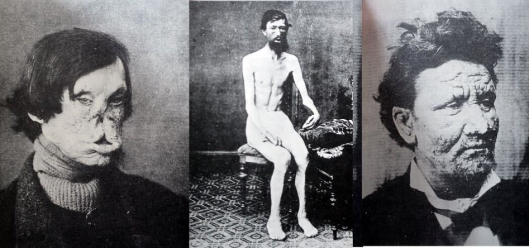 I Norge fortsatte spedalskhet å herje selv på 1900-tallet. Den norske legen Armaur Hansen (1841–1912) oppdaget at spedalskhet skyldes en infeksjon med bakterier. Bildene er fra Armaur Hansens lærebok fra 1895. (Foto lånt ut av Jesper From) I Norge fortsatte spedalskhet å herje selv på 1900-tallet. Den norske legen Armaur Hansen (1841–1912) oppdaget at spedalskhet skyldes en infeksjon med bakterier. Bildene er fra Armaur Hansens lærebok fra 1895. (Foto lånt ut av Jesper From)