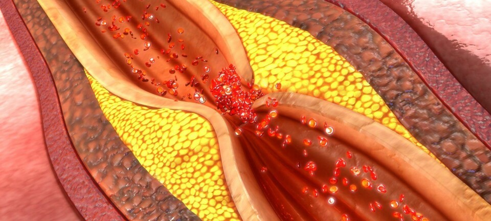 Åreforkalkning kan snevre inn blodårene rundt hjertet så mye at blodtilførselen til hjertet stopper. Da får du et hjerteinfarkt.   (Foto: sciencepics/Shutterstock/NTB scanpix)