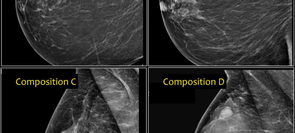 Disse brystene har ulik risiko for kreft. Fra venstre øverst fettrikt bryst som ser mørkt ut på mammografi (A) med lav risiko, via mellomtyper (B og C) til mest kjertelrikt, med stor grad av lyse partier (D). Det nederst til høyre har høyere risiko for kreft.  (Foto: Radiology Assistant)