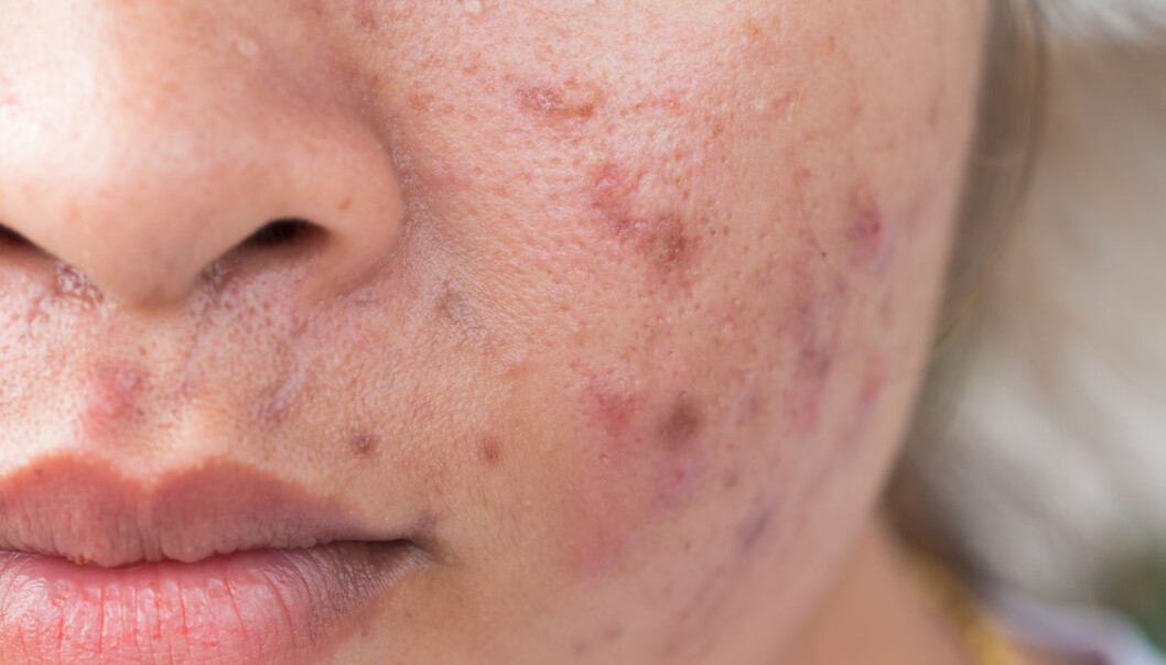 - Porene i huden blir tette av mange forskjellige grunner, og da kan talg i huden hope seg opp. Dette kan føre til en betennelse i talgkjertelen, skriver Sara Sumić. (Illustrasjonsfoto: Shutterstock / NTB scanpix) - Porene i huden blir tette av mange forskjellige grunner, og da kan talg i huden hope seg opp. Dette kan føre til en betennelse i talgkjertelen, skriver Sara Sumić. (Illustrasjonsfoto: Shutterstock / NTB scanpix)
