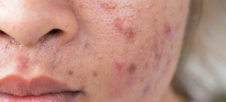 - Porene i huden blir tette av mange forskjellige grunner, og da kan talg i huden hope seg opp. Dette kan føre til en betennelse i talgkjertelen, skriver Sara Sumić. (Illustrasjonsfoto: Shutterstock / NTB scanpix)