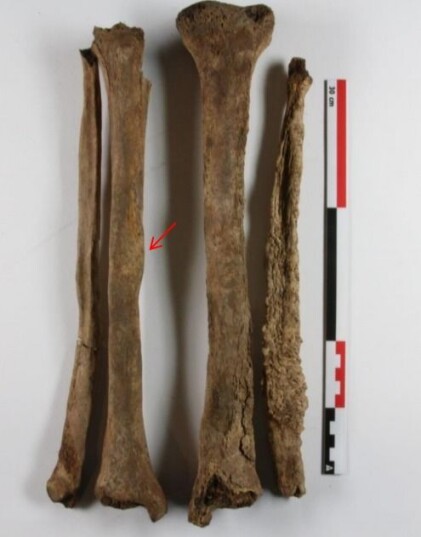 Beinbrudd og lepra: Forandringene i beinvevet er særlig tydelig på venstre legg- og skinnebein. Disse er forårsaket av lepra. Den røde pilen viser et leget beinbrudd. (Foto: NIKU) Beinbrudd og lepra: Forandringene i beinvevet er særlig tydelig på venstre legg- og skinnebein. Disse er forårsaket av lepra. Den røde pilen viser et leget beinbrudd. (Foto: NIKU)