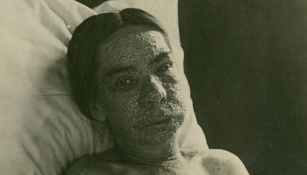 Helt frem til slutten av forrige århundre var kopper en av de mest dødelige og grusomme sykdommer et menneske kunne få. (Foto: Oslo universitetssykehus Ullevål) Helt frem til slutten av forrige århundre var kopper en av de mest dødelige og grusomme sykdommer et menneske kunne få. (Foto: Oslo universitetssykehus Ullevål)