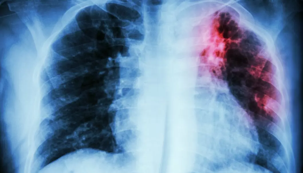 Flere får multiresistent tuberkulose i Norge