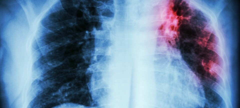 Røntgenbilde som viser lungetuberkulose i øvre venstre lunge.  (Foto: Puwadol Jaturawutthichai / Shutterstock / NTB scanpix)