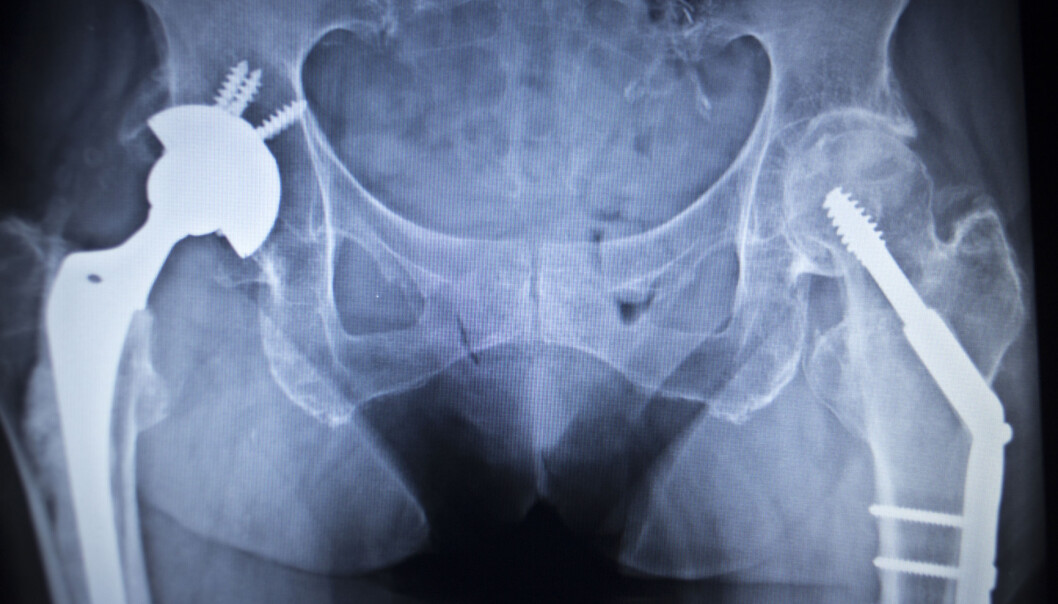 I dag er rundt 95 prosent av alle implantatoperasjoner vellykkede - mye takket være antibiotika. Men hva skjer når medisinen ikke virker lenger? (Illustrasjonsfoto: Colourbox) I dag er rundt 95 prosent av alle implantatoperasjoner vellykkede - mye takket være antibiotika. Men hva skjer når medisinen ikke virker lenger? (Illustrasjonsfoto: Colourbox)