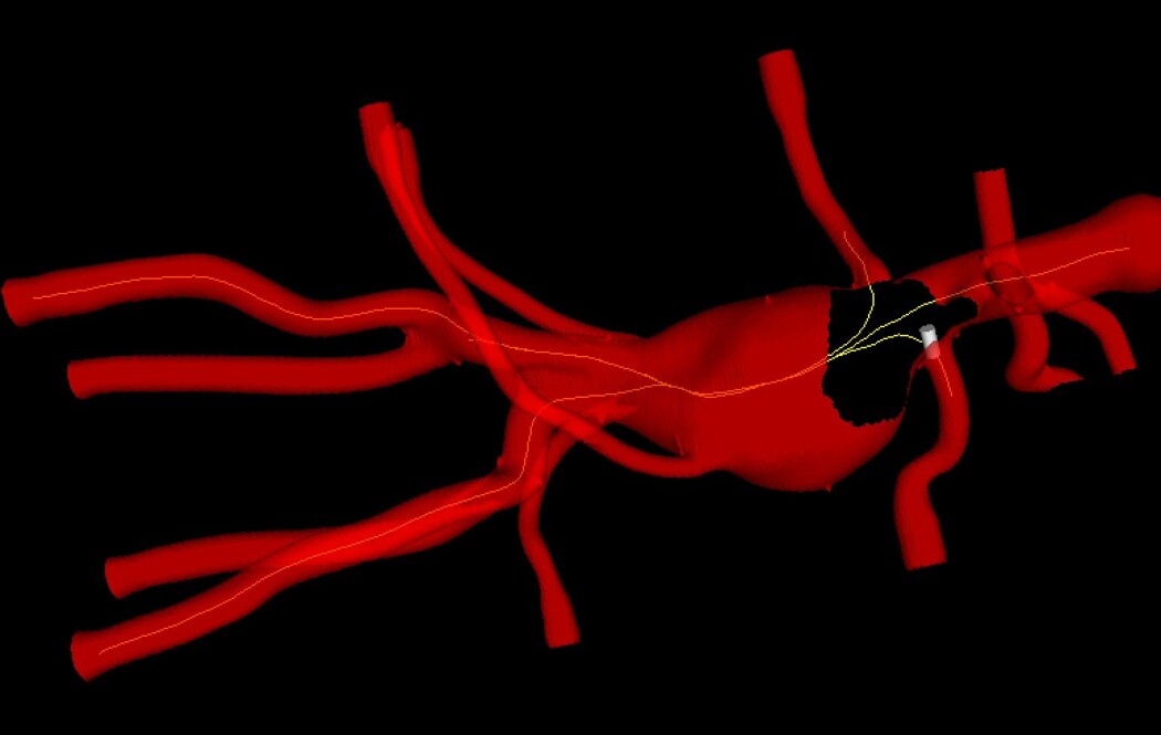 Ny teknologi gir en 3D-modell av hovedpulsåren til pasienten. I tillegg får kirurgen oversikt over hvor instrumentene befinner seg i åren. (Figur: Sintef) Ny teknologi gir en 3D-modell av hovedpulsåren til pasienten. I tillegg får kirurgen oversikt over hvor instrumentene befinner seg i åren. (Figur: Sintef)
