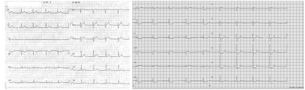 You can see a normal electrocardiogram on the left and a patient with heart disease on the right. Brand II, III, AVF, V4, V5 and V6 are displayed right after the tall spike. Keep the curve down and low before it goes up to normal. (Photo: Bundgaard et al.) You can see a normal electrocardiogram on the left and a patient with heart disease on the right. Brand II, III, AVF, V4, V5 and V6 are displayed right after the tall spike. Keep the curve down and low before it goes up to normal. (Photo: Bundgaard et al.)
