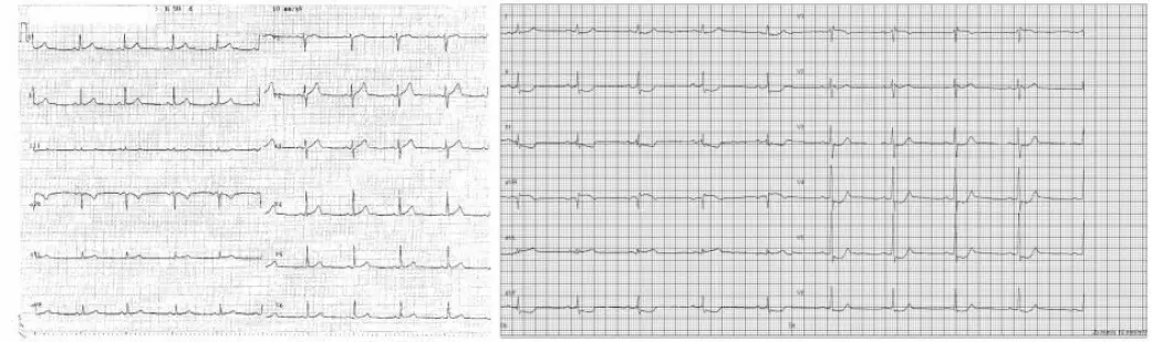 På venstre side kan du se en normalt EKG, og på høyre side kan du se hvordan det ser ut hos en pasient med hjertesykdommen. Like etter de høye piggene ser du merkene II, III, aVF, V4, V5 og V6. LIke etter det «dykker» kurven ned og forblir lav før den igjen stiger til et normalt nivå. (Foto: Bundgaard et. al.)