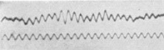 Hjernesignaler, en av de første gangene noen klarte å måle dem, i 1929. (Kilde: Hans Berger) Hjernesignaler, en av de første gangene noen klarte å måle dem, i 1929. (Kilde: Hans Berger)