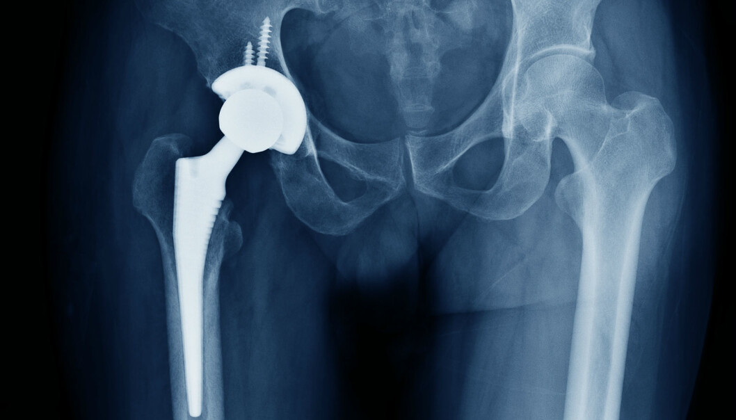 I dag er det relativt udramatisk å bytte hofte. Men i fremtiden kan det samme inngrepet være risikabelt og nesten umulig å gjennomføre fordi post-operative infeksjoner ikke kan behandles med antibiotika. (Foto: Shutterstock / NTB scanpix) I dag er det relativt udramatisk å bytte hofte. Men i fremtiden kan det samme inngrepet være risikabelt og nesten umulig å gjennomføre fordi post-operative infeksjoner ikke kan behandles med antibiotika. (Foto: Shutterstock / NTB scanpix)