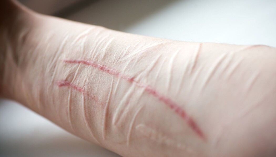 Selvskading kan både være selvmordsforsøk eller ikke selvmordsrelaterte, og spenner fra overfladiske hudrisp til livstruende skader. Det er vanligst blant ungdommer og unge voksne. (Foto: Olga Sapegina, Shutterstock, NTB scanpix) Selvskading kan både være selvmordsforsøk eller ikke selvmordsrelaterte, og spenner fra overfladiske hudrisp til livstruende skader. Det er vanligst blant ungdommer og unge voksne. (Foto: Olga Sapegina, Shutterstock, NTB scanpix)