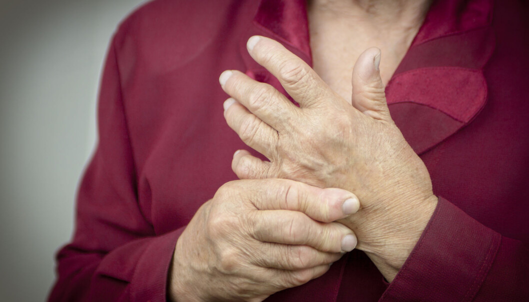 Leddgikt er en smertefull sykdom som ødelegger leddene i blant annet hendene. Medisiner som bremser skader på bein og brusk, kan gi pasientene et bedre liv. (Foto: Shutterstock/NTB scanpix) Leddgikt er en smertefull sykdom som ødelegger leddene i blant annet hendene. Medisiner som bremser skader på bein og brusk, kan gi pasientene et bedre liv. (Foto: Shutterstock/NTB scanpix)