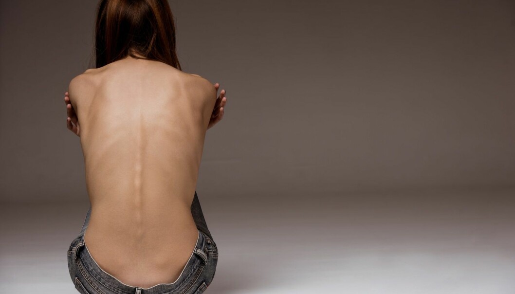 Kan ha funnet genetisk sårbarhet for anoreksi