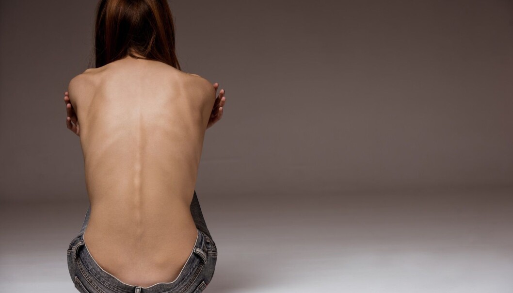 – Dersom man etter hvert oppfatter anoreksi som både en psykisk og en metabolsk sykdom, vil kanskje interessen for å forsøke å utvikle medisiner for behandling bli stimulert, sier norsk forsker. (Foto: Shutterstock / NTB scanpix) – Dersom man etter hvert oppfatter anoreksi som både en psykisk og en metabolsk sykdom, vil kanskje interessen for å forsøke å utvikle medisiner for behandling bli stimulert, sier norsk forsker. (Foto: Shutterstock / NTB scanpix)