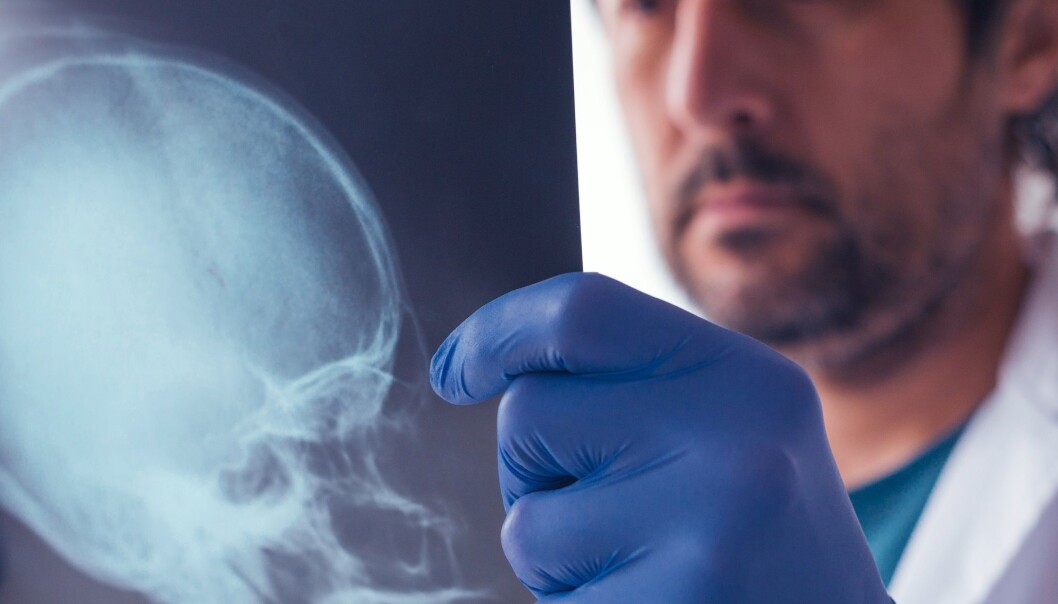 Dette er en av de første studiene der forskere har målt promillen hos en høy andel av de som blir innlagt med hodeskader.
(Foto: igorstevanovic / Shutterstock / NTB scanpix) Dette er en av de første studiene der forskere har målt promillen hos en høy andel av de som blir innlagt med hodeskader.
(Foto: igorstevanovic / Shutterstock / NTB scanpix)