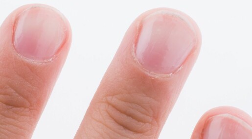 Ny app kan avsløre blodmangel med et bilde av neglene dine