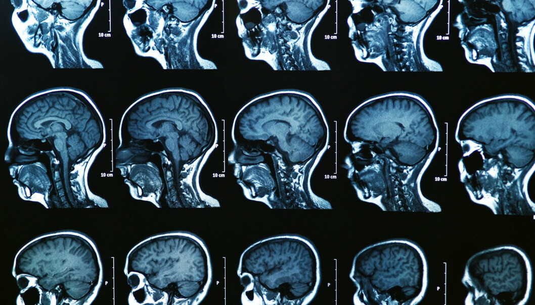 Nettverket i hjernen vår er helt unikt for hver enkelt av oss. Nå viser det seg at forskere kan bruke dette nettverket til å avsløre tidlige tegn på psykiske lidelser. (Illustrasjonsfoto: Colourbox) Nettverket i hjernen vår er helt unikt for hver enkelt av oss. Nå viser det seg at forskere kan bruke dette nettverket til å avsløre tidlige tegn på psykiske lidelser. (Illustrasjonsfoto: Colourbox)
