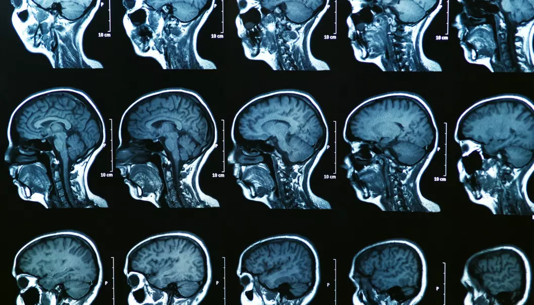 Unikt hjernemønster kan avsløre tegn på psykisk sykdom