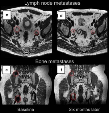 Bilder av kreftpasientenes svulster i lymfevev og beinvev før (venstre) og seks måneder etter (høyre) behandling med immunterapivaksine. De røde sirklene viser størrelsen på svulstene, og her ser du at de har krympet på bildene til høyre. (Foto: Wolfgang Lilleby/Cancer Immunology, Immunotherapy) Bilder av kreftpasientenes svulster i lymfevev og beinvev før (venstre) og seks måneder etter (høyre) behandling med immunterapivaksine. De røde sirklene viser størrelsen på svulstene, og her ser du at de har krympet på bildene til høyre. (Foto: Wolfgang Lilleby/Cancer Immunology, Immunotherapy)