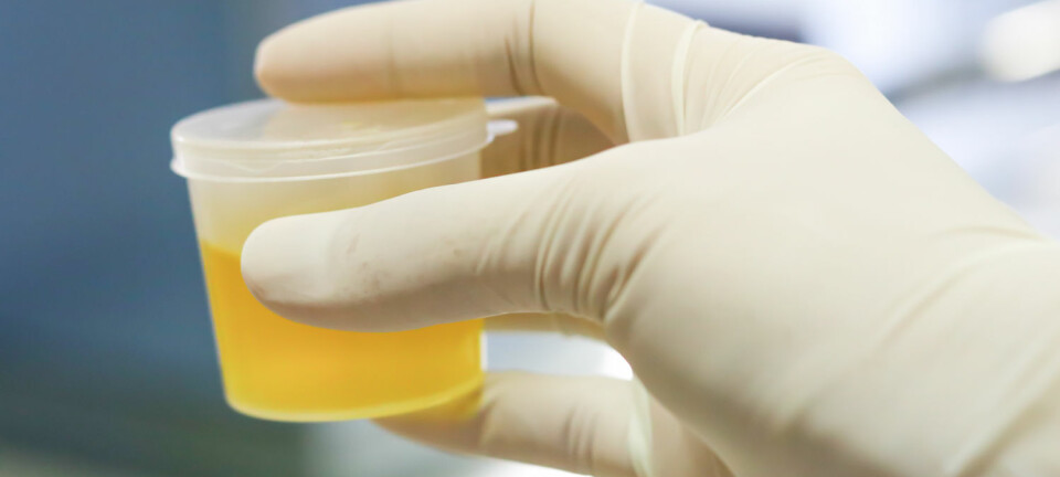 Forskere ved Universitetet i Oslo forsøker å finne fram til en «merkelapp» som bare finnes i urinen hos mennesker med blærekreft, og som kan identifiseres på en forholdsvis enkel måte. (Illustrasjonsfoto: BENCHAMAT / Shutterstock / NTB scanpix)
