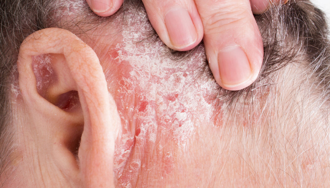 Ikke alle som har psoriasis rammes like hardt. Ny forskning bekrefter mistanken om at det er kjønnsforskjeller. (Foto: Lipowski Milan / Shutterstock / NTB scanpix) Ikke alle som har psoriasis rammes like hardt. Ny forskning bekrefter mistanken om at det er kjønnsforskjeller. (Foto: Lipowski Milan / Shutterstock / NTB scanpix)