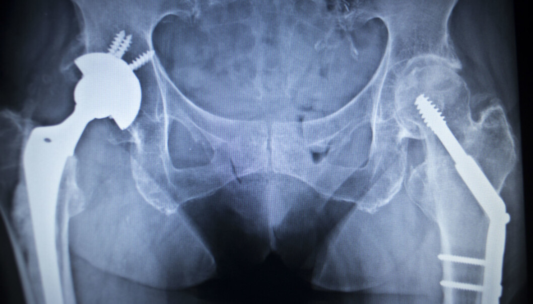 Å få operert inn et implantat i hoften kan på grunn av antibiotikaresistens, bli skjebnesvangert for en pasient om 40 år. (Illustrasjonsfoto: Colourbox) Å få operert inn et implantat i hoften kan på grunn av antibiotikaresistens, bli skjebnesvangert for en pasient om 40 år. (Illustrasjonsfoto: Colourbox)