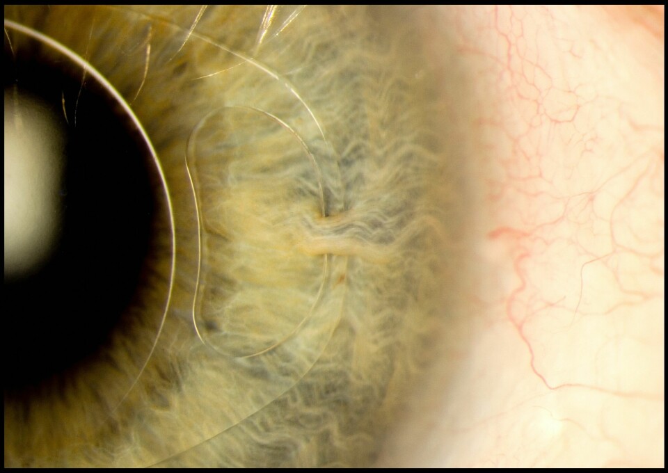 En interokulær linse er en kunstig linse som blir operert inn på øyet for å behandle for eksempel nærsynthet eller grå stær. «Håndtakene» på siden holder linsen på plass. (Foto: Mark Bartley, Cambridge University Hospitals NHS Foundation Trust)