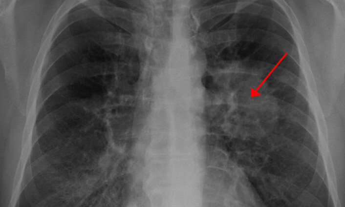 Lungekreft, sett på røntgenfoto.  (Foto: (Bilde: James Heilman, MD, Creative Commons Attribution Share-Alike 3.0 Unported))