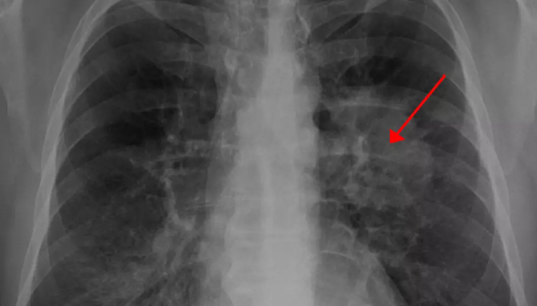 Lungekreft, sett på røntgenfoto.  (Bilde: James Heilman, MD, Creative Commons Attribution Share-Alike 3.0 Unported)