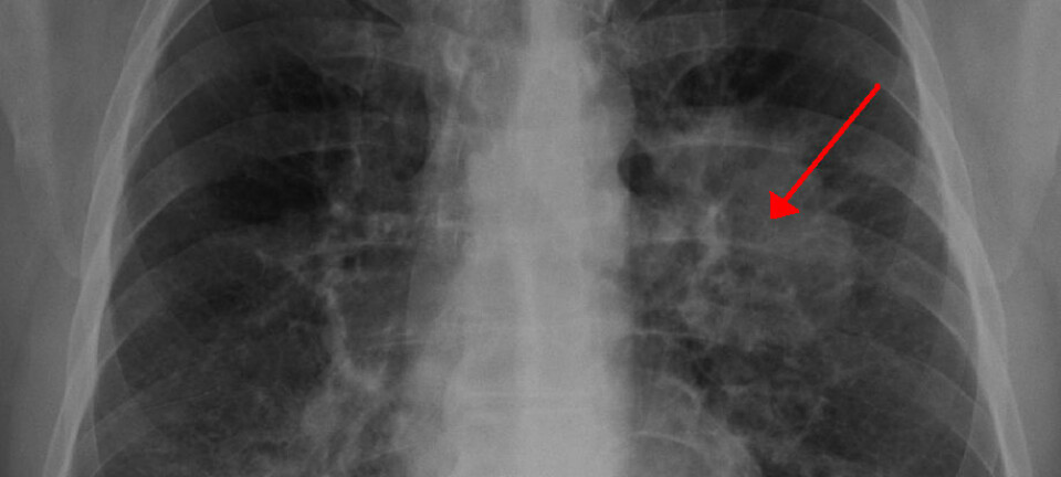 Lungekreft, sett på røntgenfoto.  (Bilde: James Heilman, MD, Creative Commons Attribution Share-Alike 3.0 Unported)