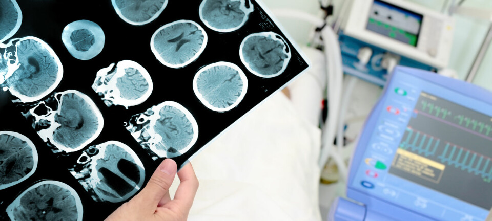 - Hjernekreften glioblastom er den vanlegaste og mest alvorlege kreften i hjernen hos vaksne, og rammar om lag 300 personar i Noreg per år. (Foto: Shutterstock / NTB scanpix)