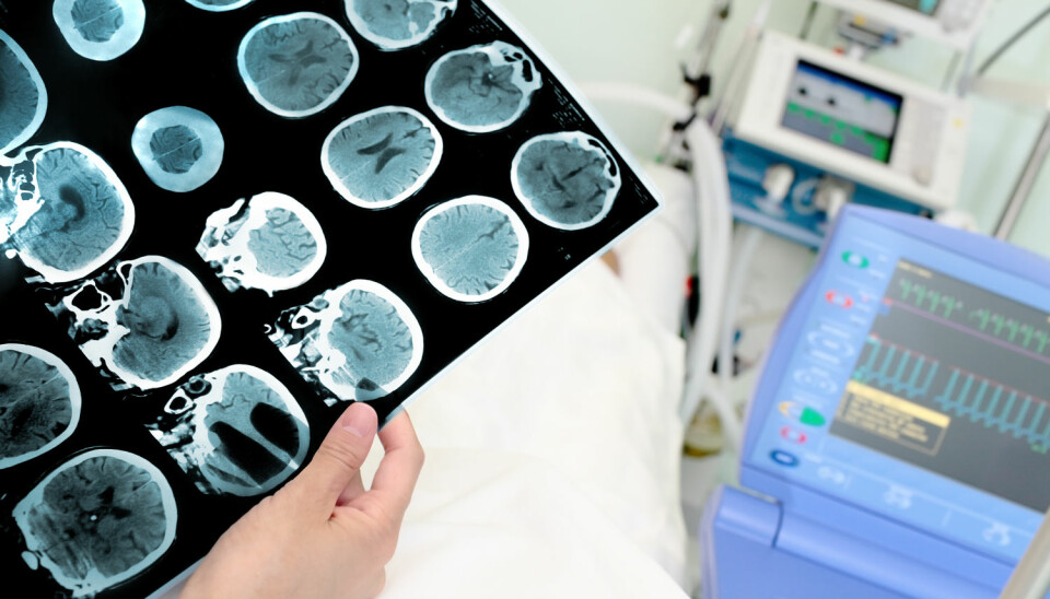 - Hjernekreften glioblastom er den vanlegaste og mest alvorlege kreften i hjernen hos vaksne, og rammar om lag 300 personar i Noreg per år. (Foto: Shutterstock / NTB scanpix)
