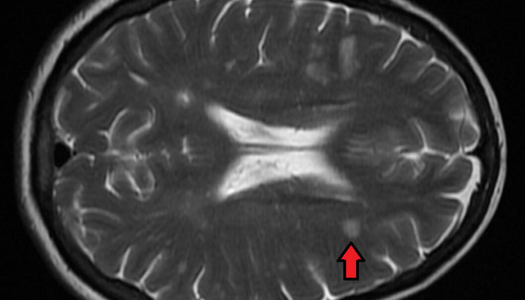 MR-bilde av hjernen til en pasient med MS. Den røde pilen viser betennelse - en flekk hvor immunsystemet angriper hjernecellene. (Foto: James Heilman, MD, Wikimedia commons CC BY-SA 4.0) MR-bilde av hjernen til en pasient med MS. Den røde pilen viser betennelse - en flekk hvor immunsystemet angriper hjernecellene. (Foto: James Heilman, MD, Wikimedia commons CC BY-SA 4.0)