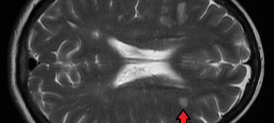 MR-bilde av hjernen til en pasient med MS. Den røde pilen viser betennelse - en flekk hvor immunsystemet angriper hjernecellene.  (Foto: James Heilman, MD, Wikimedia commons CC BY-SA 4.0)